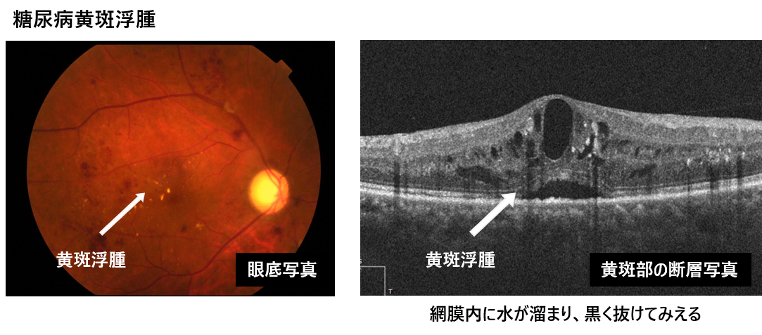 糖尿病黄斑浮腫