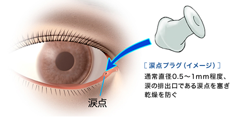 涙点プラグ